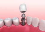 Одномоментная имплантация зубов: преимущества и особенности