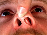 Искривление носовой перегородки