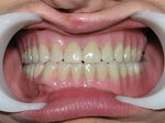 Съемное протезирование зубов: Цены, разновидности и особенности съёмного протезирования зубов