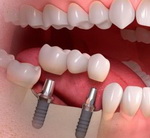 Выбор клиники для имплантации зубов