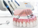Можно ли полностью восстановить зубной ряд за один прием стоматолога? Все о протезировании на четырех имплантах