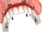 О скуловых имплантатах и стоматологических винирах: полезные сведения