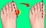 Как правильно лечить «шишку» на ноге и когда нужна операция? 