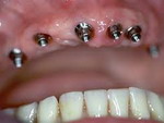 Как имплантируют зубы?