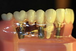 Имплантация зубов - множество преимуществ