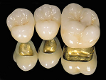 Имплантация зубов: преимущества, противопоказания